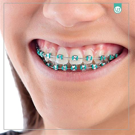 instalacion de ortodoncia metalica wecare