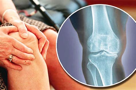 managing degenerative arthritis tips  treatment options  dr