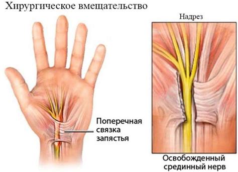 Как лечить нейропатию срединного нерва на руке