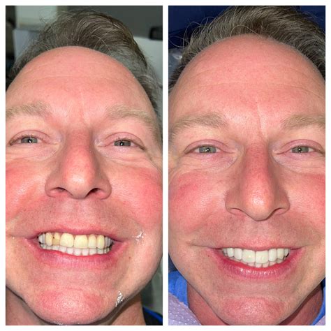 Before & After Dental Results at Relax Dental, Burlington NC