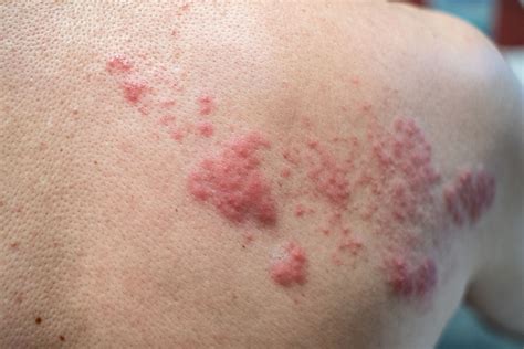 questions    healthcare provider  shingles skin