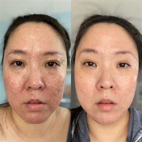 Face Before and After Vitamin C Serum: Astonishing Transformation Unveiled!