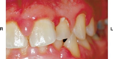 Oral Histology: Part 2 - Clinical Characteristics of the Gingiva Flashcards | Quizlet