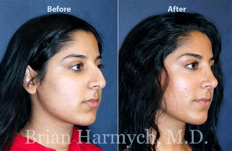 nose surgery near me prices - Chante Vaughan