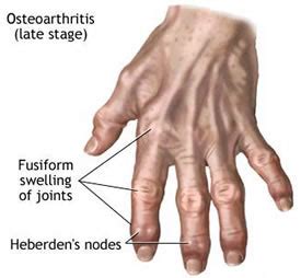 Hand and Finger Arthritis Treatment | London Hand Surgeon
