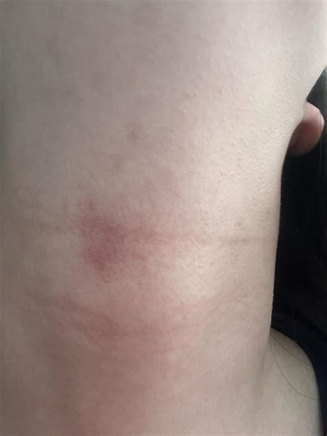 Very Itchy rash, worried it might be something worse : r/skin