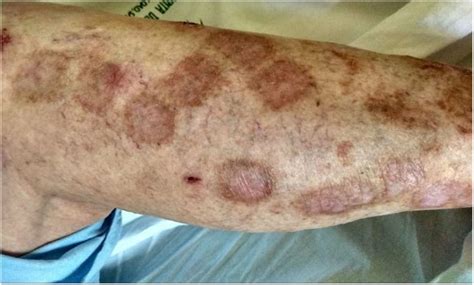 immunotherapy induced colitis    ulcerative colitis