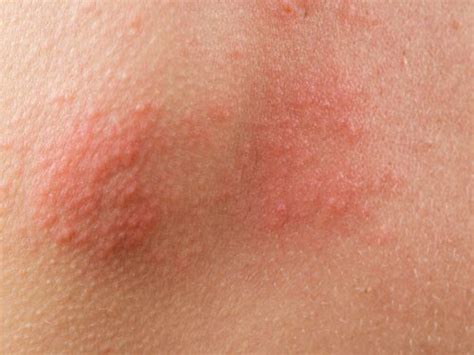 effective tips  managing shingles
