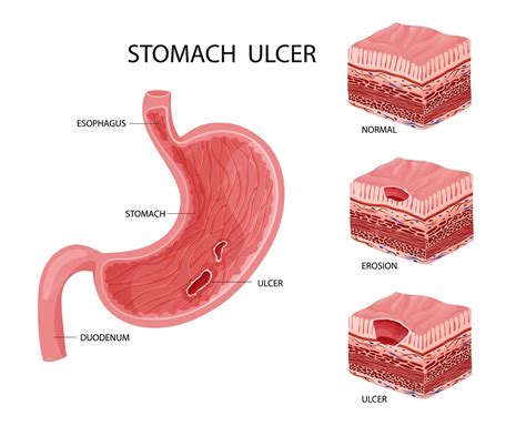 Premium Vector | Stomach erosion and ulcer illustration