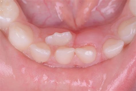 denti inferiori storti denti storti nei bambini  intercettare le