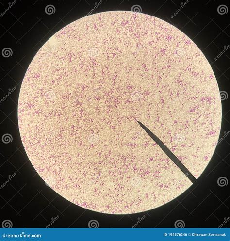 Abnormal Red Blood Cells From Anemia Patient Stock Photo
