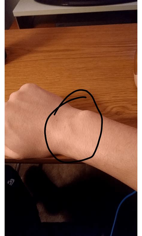 Can carpal tunnel syndrome cause pain at the top of the wrist? : r