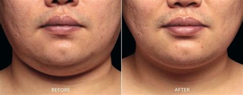 CoolSculpting Chin | Reduce Double Chins & Neck Fat