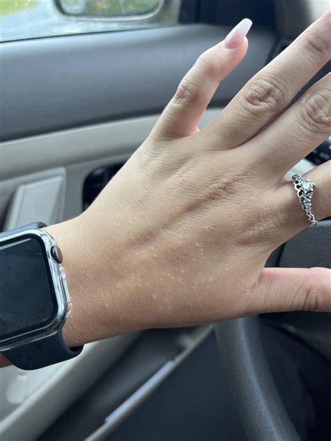 small itchy skin colored bumps      hands