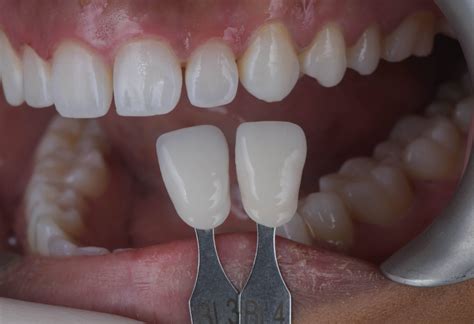 Ceramic Bonding | Marylebone Smile Clinic