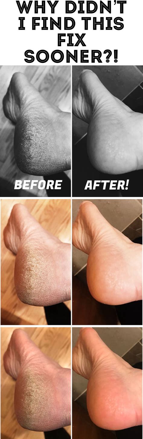 What's The Best Thing To Soak Your Feet In For Calluses at Nelson