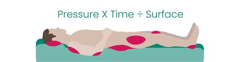 Pressure Ulcers - Definition, Assessment, and Prevention