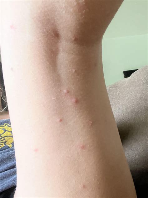 Mysterious bug bites : r/bugbite