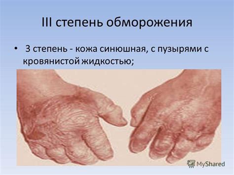 Презентация на тему: "Обморожение. Первая помощь при обморожении. Как ...