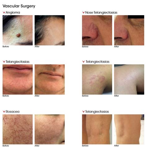 K-LASER BLUE – DERMA | Imex Medical Limited