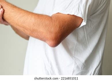 Man Swelling Erythematous Lump Pain Elbow Stock Photo 2216851011 ...