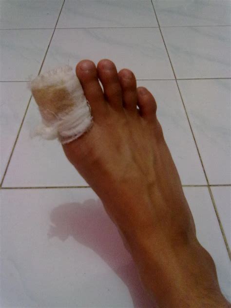 kaki lecet jatuh  motor perumperindocoid