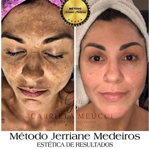 Qual Acido Para Melasma