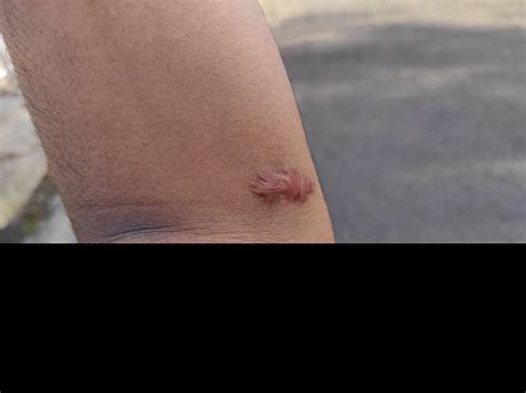 Scarring in Diverse Populations | WoundSource