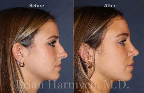 rhinoplasty nose surgery  cleveland