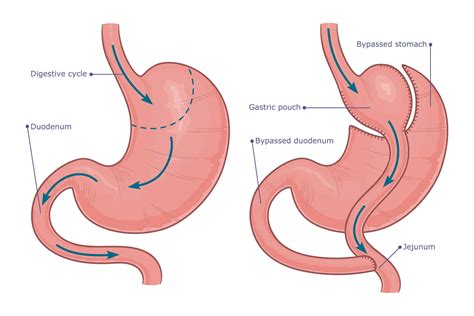 Why Would You Gain Weight After Surgery at Ashley Bruny blog