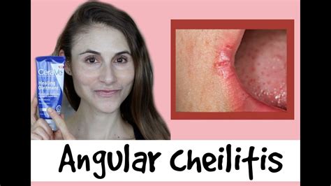 Angular cheilitis causes & treatments: a Q&A with dermatologist Dr Dray ...