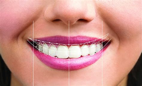 smile designing  kukatpally   perfect smile  dermadent
