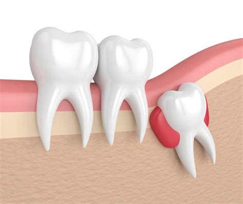 Impacted Tooth Warning Signs - Salvaggio Dentistry