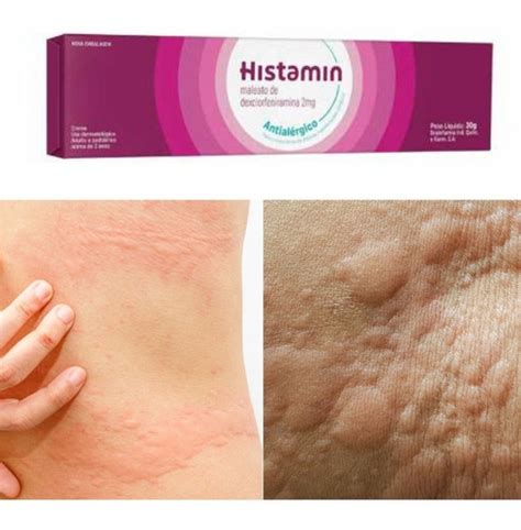 Anti Histaminico Para Coceira Na Pele
