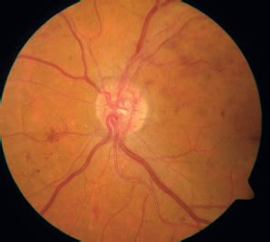 Proliferative Diabetic Retinopathy. | Download Scientific Diagram