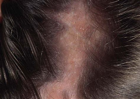 Fungal Infection In Hair - malayhaxac