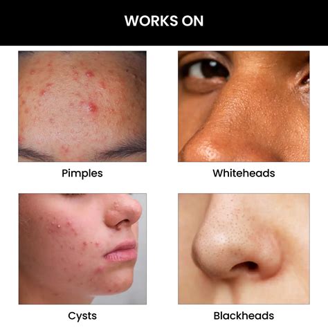 ThriveCo Goodbye Acne Kit with Facial Cleanser & Face Serum