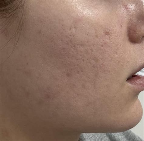 Holes in face : r/Skincare_Addiction