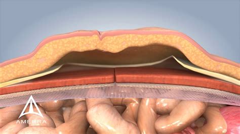 Ventral Hernia Pictures : Laparoscopic Ventral Hernia Repair With ...