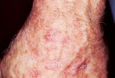 skin cancer pictures