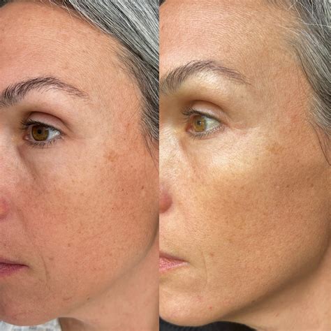 how long does it take retinol to work 8