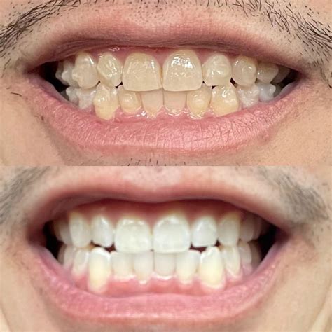 Crest White Strips FTW! Day 10/20 After Invislign : r/Invisalign