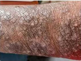 common hiv skin conditions  africans   treatment