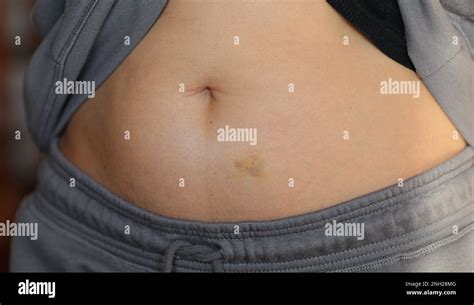 Adult woman with green yellow bruise, hematoma on her stomach at home ...