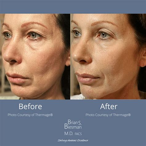 Thermage Noninvasive Skin Tightening | Nashville, TN
