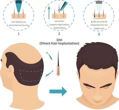 DHI Method Hair Transplant - Medousa Clinique