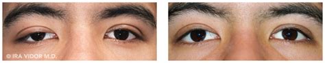 ptosis-before-and-after-3-900x175 | Dr Vidor