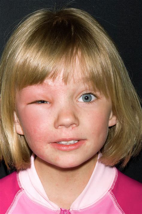 allergic reaction photograph  dr p marazziscience photo library