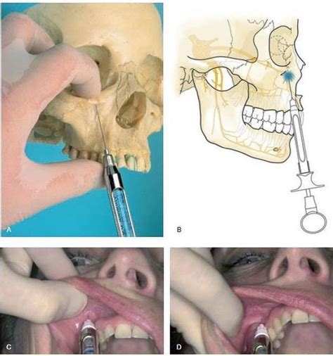 All Dental / Вся Стоматология on Instagram: “Инфраорбитальная анестезия ...