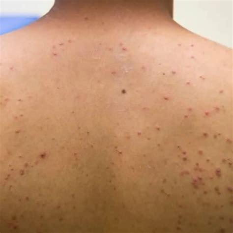 pelo encarnado inflamado  hacerpesquisa  tiktok